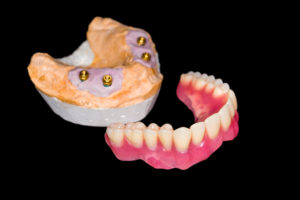 Implant supported denture